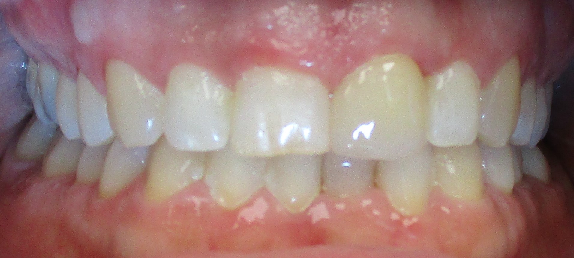 CROOKED FRONT TOOTH FIXED INVISALIGN
