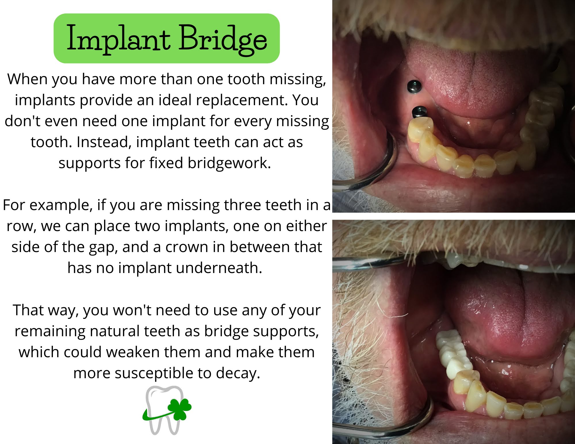 Implant Bridge New Haven Dental Dr. Moser